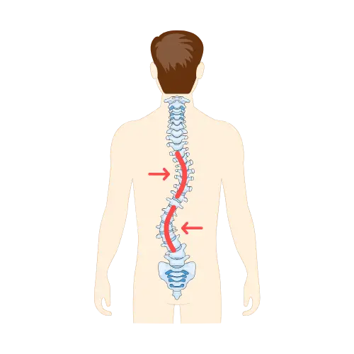 Escoliosis